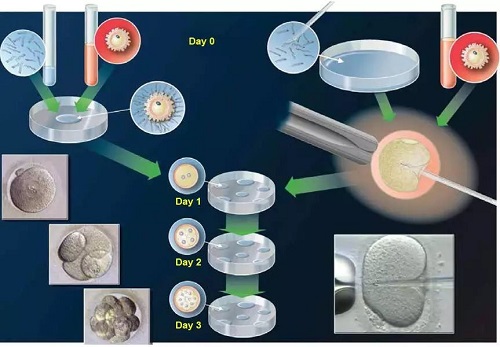 试管婴儿方案有哪几种？